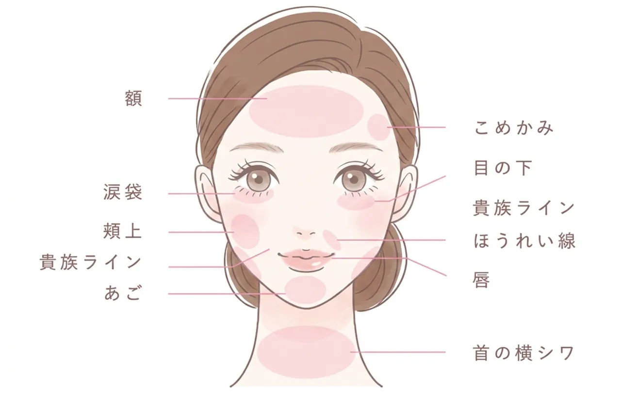 ヒアルロン酸注入部位