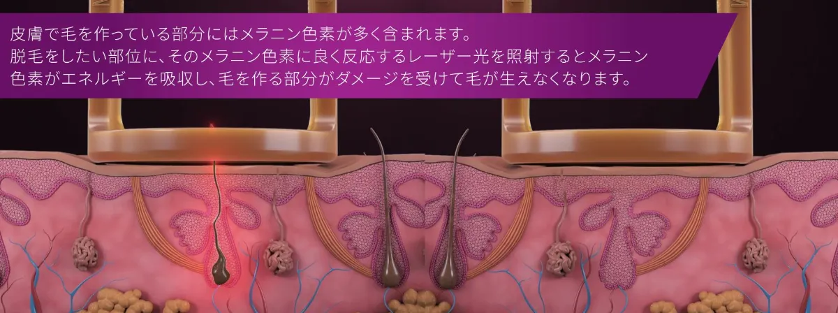 ジェントルマックスプロプラスの特徴