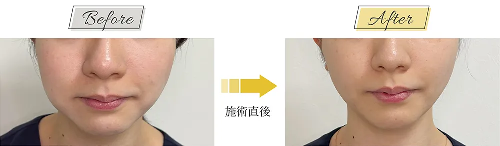 糸リフトでたるみ・輪郭改善