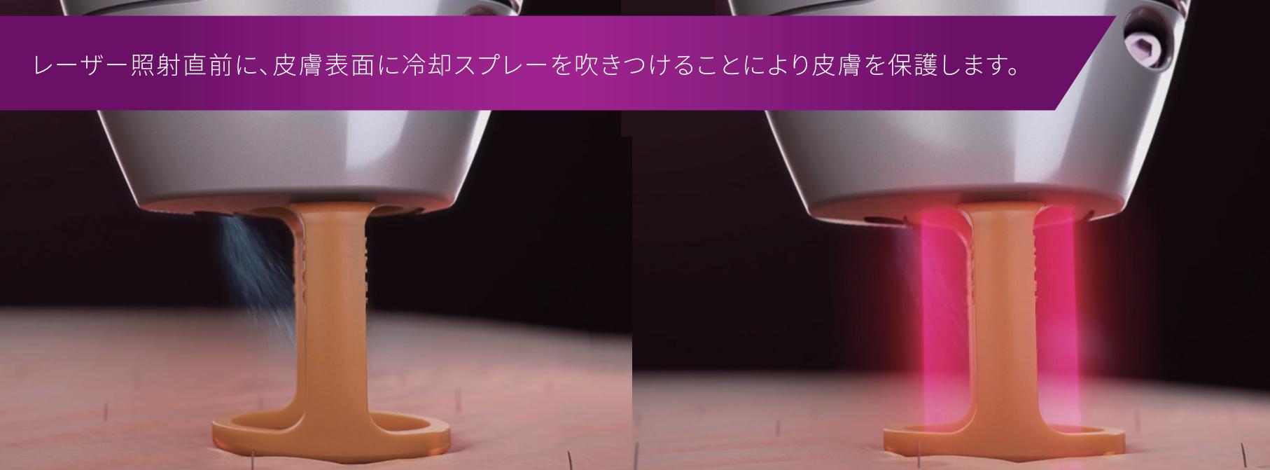 ジェントルマックスプロプラスの特徴