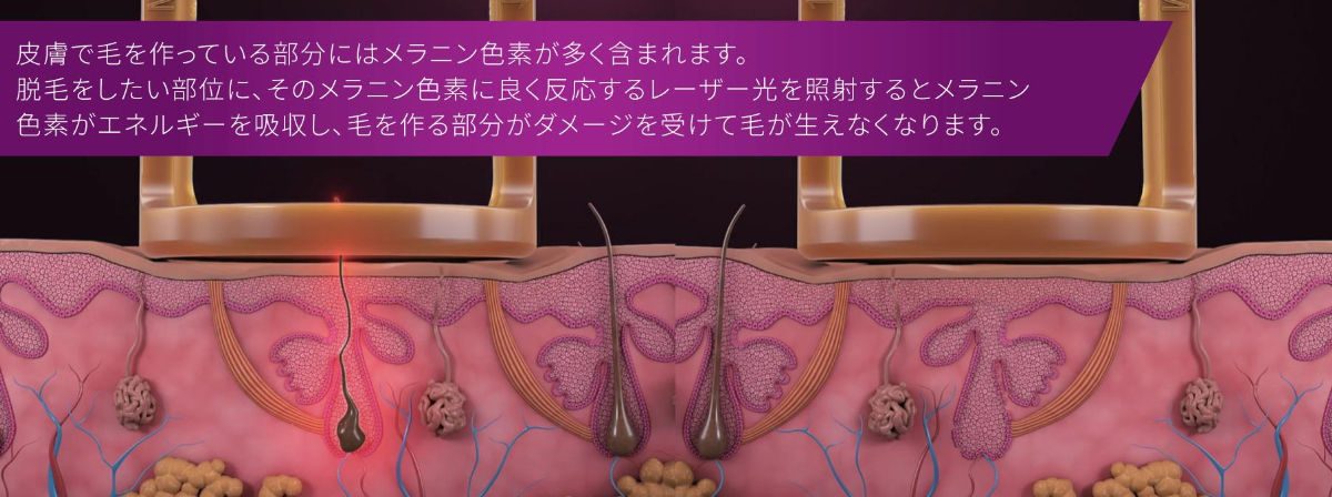 ジェントルマックスプロプラスの特徴
