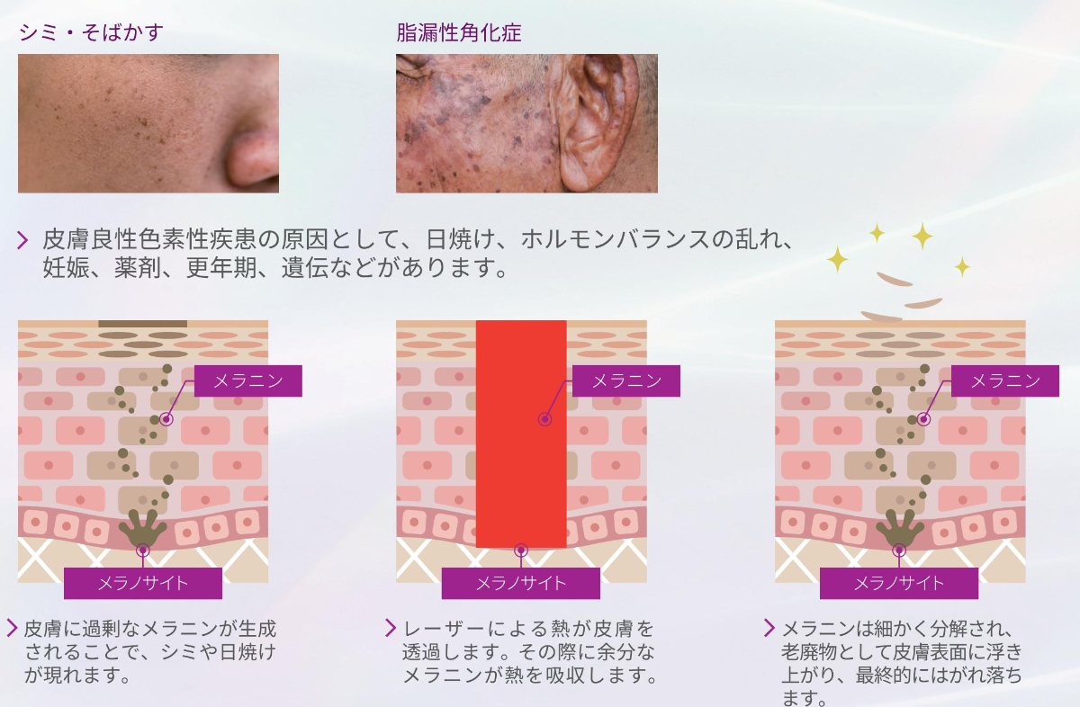 ジェントルマックスプロプラスの美肌・エイジングケア効果