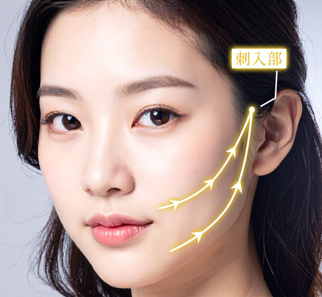 糸リフト施術のイメージ写真