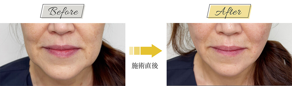 糸リフト症例写真 飯田橋 50代女性