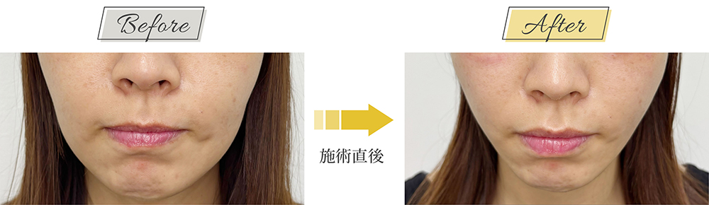 糸リフト症例写真 飯田橋 30代女性