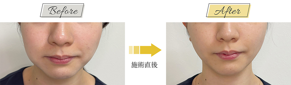 糸リフト症例写真 飯田橋 20代女性